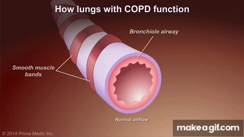 Healthy lung vs COPD lung